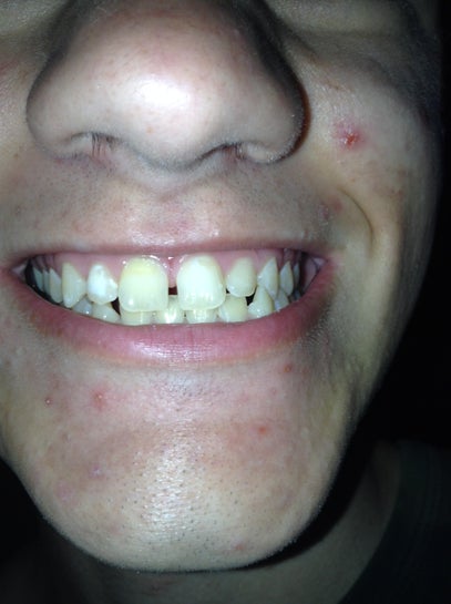 How Long Will It Take To Close My Two Front Teeth Gap Photo
