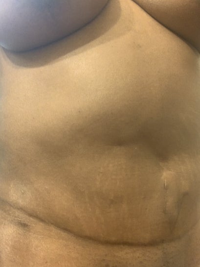 8 months post-op - Why my upper ab bigger after tummy tuck and muscle  repair? (Photos)