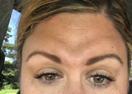Is It Normal To Have V Formation In Forehead 72 Hrs After Botox Photos