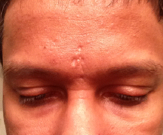 best filler for indented scars