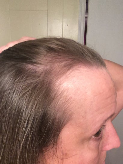 In Need Of Frontal Bossing With Forehead Reduction Hairline Lowering And Possible Hair Grafts Do I Have Other Options Photo It may also include protrusion of both frontal prominences, albeit with a normal midline. forehead reduction hairline lowering