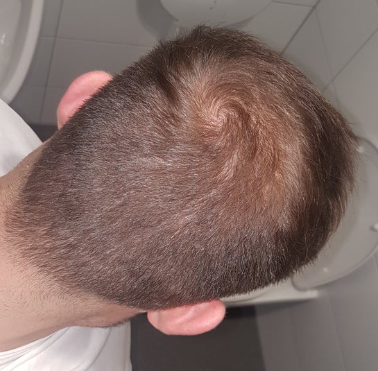 I Got a Hair Transplant at 29  Heres What to Expect When Getting a New  Hairline  Modena Hair Institute