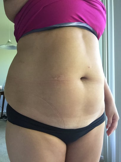 Clinic 360 - Curious about the difference between #Liposuction and  #Abdominoplasty? Many people get these two procedures confused.  🌸Liposuction is a surgical procedure that helps shape and contour body  areas by removing
