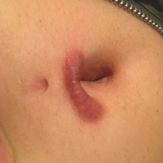 Can you pierce scar tissue on your belly button sales
