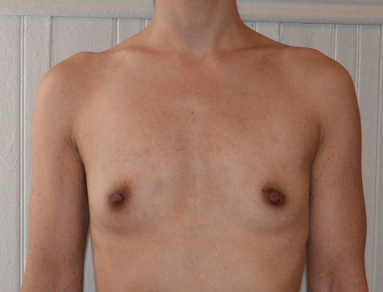 Do I have breast hypoplasia? What can I do to correct this?