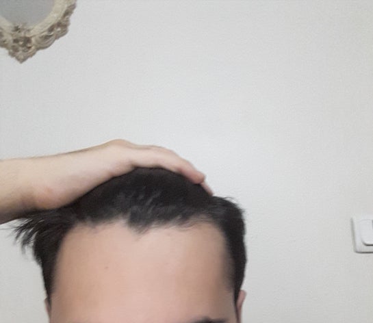 normal hairline