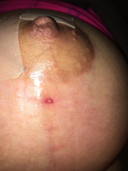 What do I do about blood blister on 4 month old breast lift scar? (Photos)