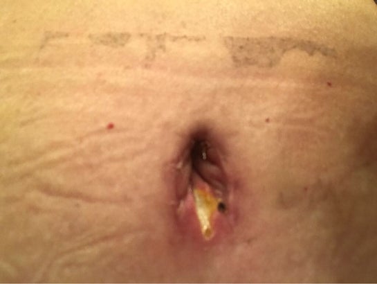 What is happening? Incisions going nuts! Slough? Dehiscence? Please help!  (Photo)