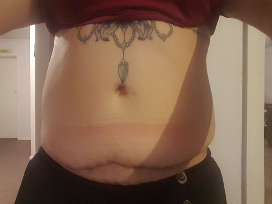 My tummy tuck experience gone wrong (Photo)