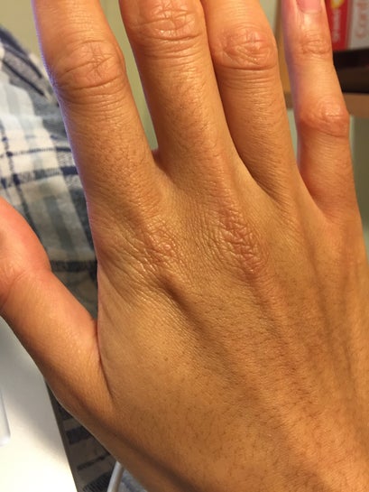 Laser Resurfacing For Crepey Wrinkled Skin On Sun Damaged Hands Photo