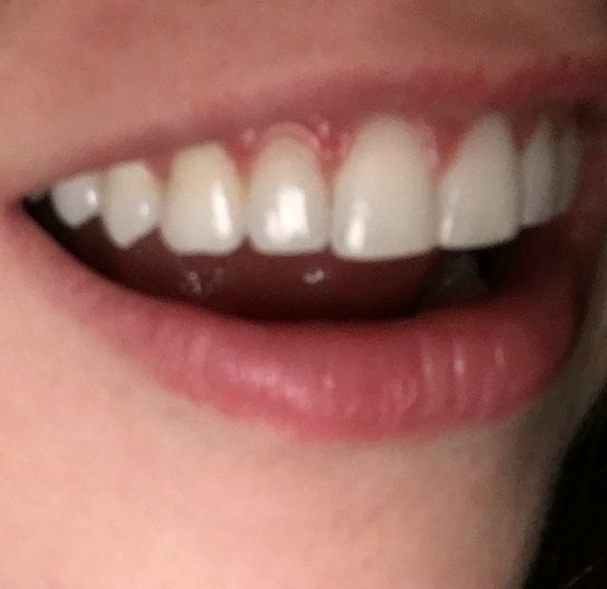 Your Opinion On My Teeth After Braces Is There Anything I Can Do I Think That My Front Teeth Stick Out After Braces Photo