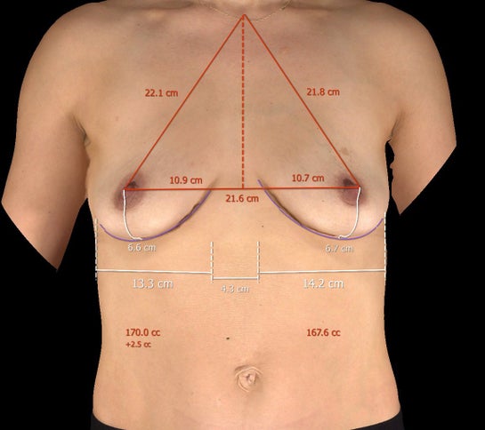 The Complete Guide to Breast Width Diameter and Implant Size