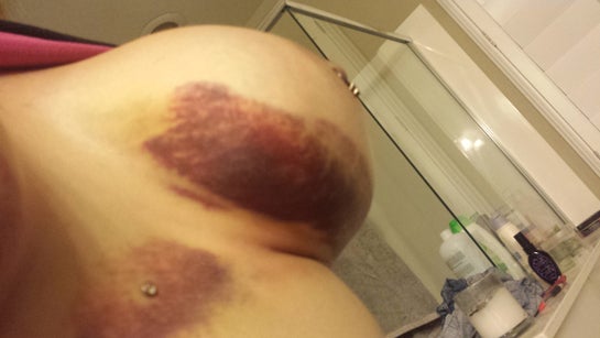 Bruising After Breast Augmentation