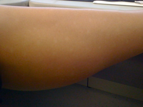 Delayed Hypopigmentation After Laser Hair Removal