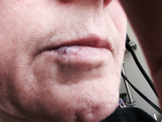 Can Anything Be Done To Minimize A Venous Pool On The Lip Photo