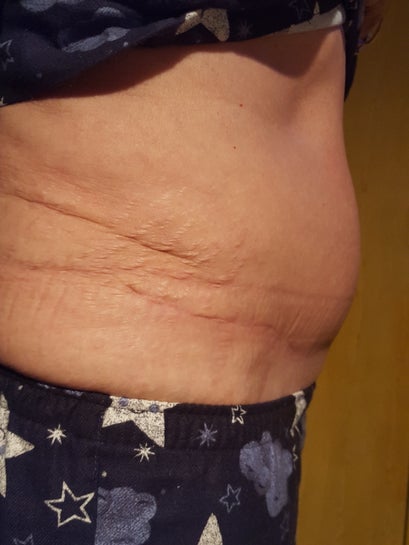 Mother, 47, is left with grapefruit-sized swellings on her stomach by a  'botched' tummy tuck