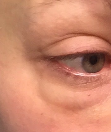 Fluid retention deals in eyes