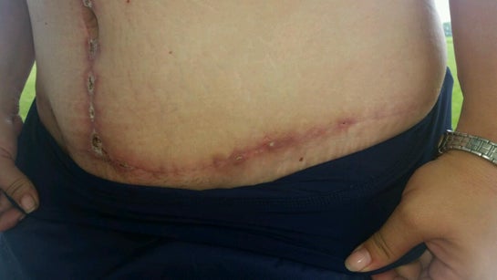 White substance in drain 2 weeks after tummy tuck? (Photo)