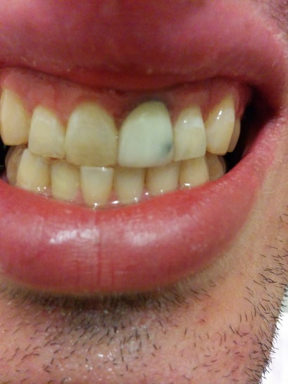 Dental Crown Turning Blue What Is The Cause Of This Is It Important To Be Replaced Photo