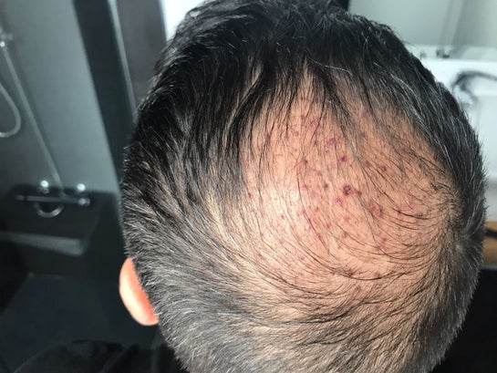 Tunio Aesthetics on Twitter After 5 Months Hair Transplant Result Of Our  Client From Norway Book Free Consultation Now httpstcobF1k0QoCzY  Call  Whats App 971 551334093 HairTransplant FUEHairTransplant  HairTransplantResults 