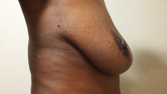 If I am a sagging C cup, could I get implants to make it a full C cup?  (photos)