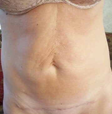 Abdominoplastia sau tummy tuck