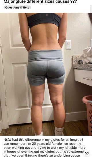 Severe glute imbalance what is the cause and how can I fix it Photo