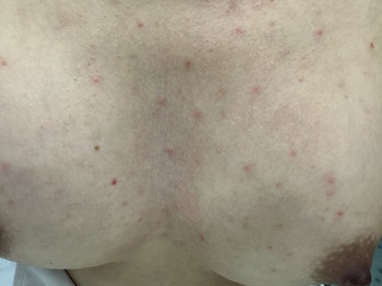 Chest/breast rash after breast augmentation - is this normal? (photos)