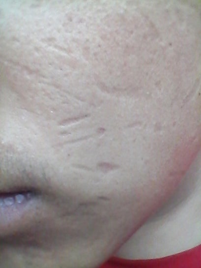 is this a scar? : r/AcneScars