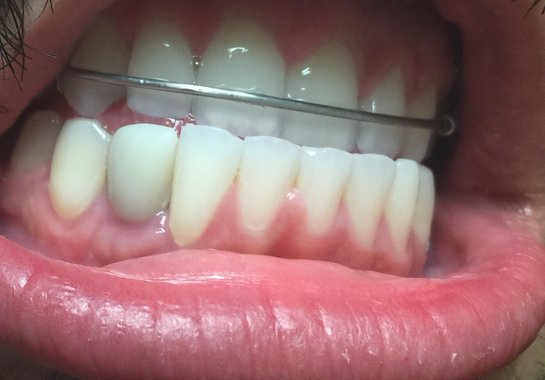 Why do crowns turn grey?