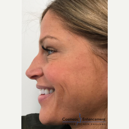 What are the flanks, and why is it so hard to get rid of fat there? -  Cosmetic Enhancement Center of New England