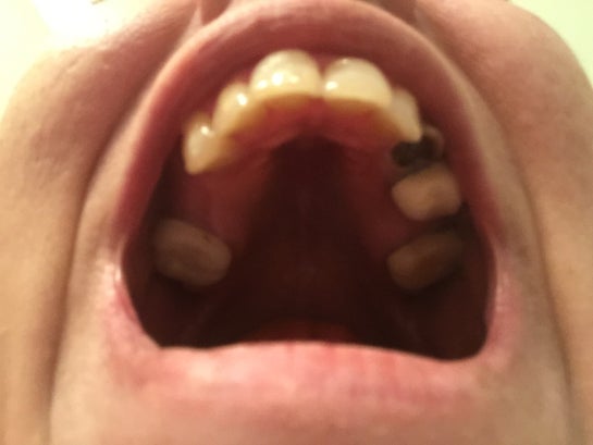 Previous root canal tooth broke in half and now in the front. I'm so scared they won't be able to crown it (Photo) Previous root canal tooth broke in half and now in the front. I'm so scared they won't be able to crown it (Photo)