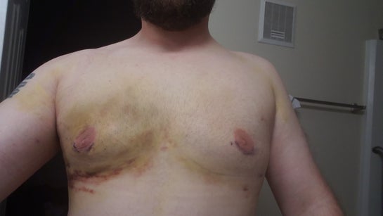 10 Days Post Op Of Gynecomastia Incision And Lipo Bruising And Swelling Returned To One Side Why