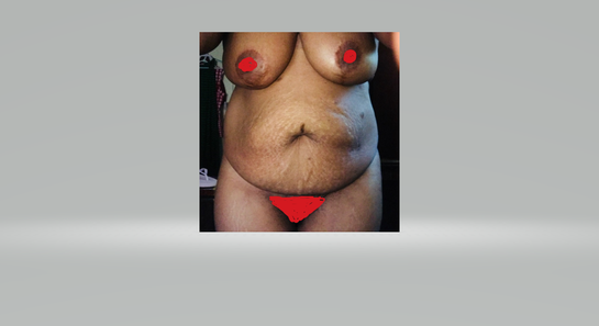 Tummy Tuck vs Panniculectomy