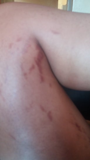 bleaching cream for stretch marks