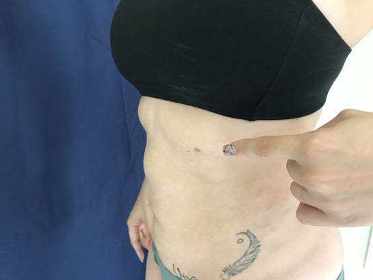 Hooked under breast-below knee full closed back liposuction