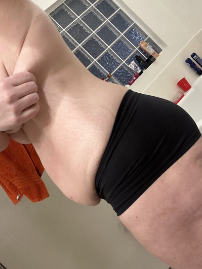 Will I be ok getting a standard tummy tuck instead of an extended tummy tuck?  Will the skin on my sides be addressed? (Photo)