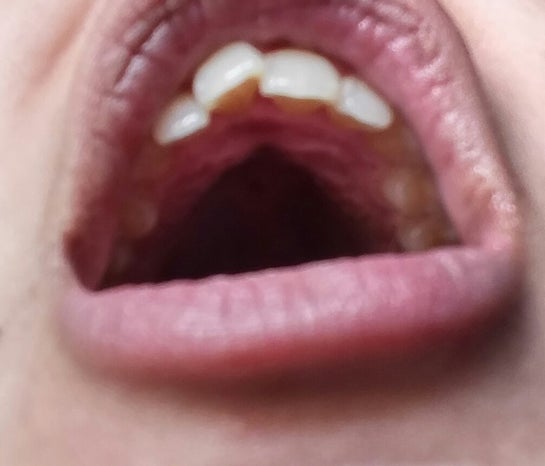 What Can I Do To Fix A Protruding Front Tooth Photo