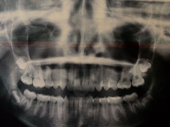 nasal septum radiograph