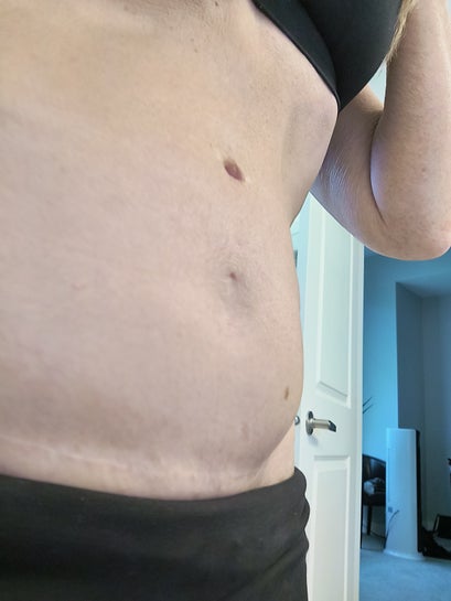 Can my botched tummy tuck be fixed? (photos)