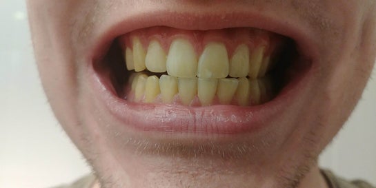 ICON White Spot Removal On Teeth, Dr. Desiree Yazdan