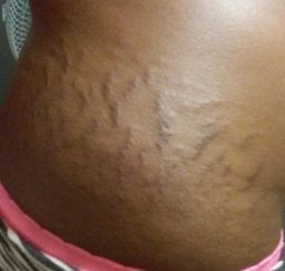 Cost of laser treatment for stretch marks in south africa Black Stretch Mark Removal Options On African American Skin Photo