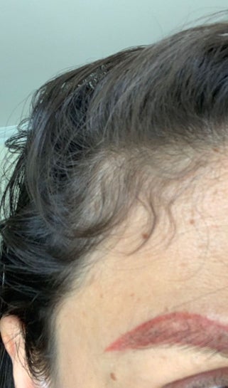 Eyebrow Tattoo Removal Picosure After Nd Yag Ink Turned Brighter Red Photo