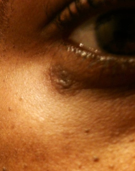 What can to done to to fade or remove the cigarette burn scar under my eye?  (Photo)