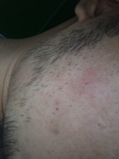 skin craters on face