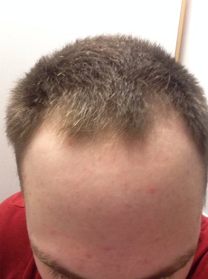 24 years old, hairline has been receding for 5 years. Am I a good 