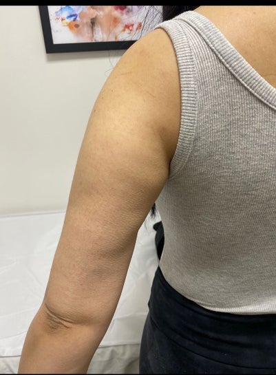 Botched arm lipo is it possible to gain weight on my arms after