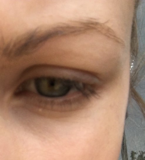 fine lines under eyes at 23