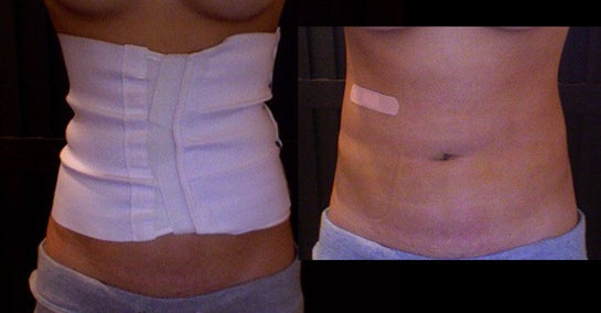 Corseting Garments After Rib Removal Surgery - Explore Plastic Surgery