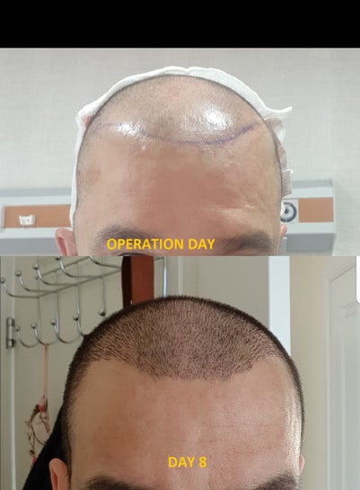 Hair Transplants for Men - Hair Repair Clinic